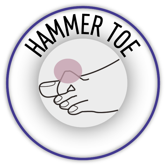 Illustration of hammer toes. Explore TDO shoes for hammer toes